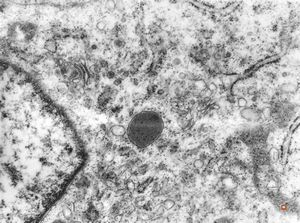 F, 61y. | malignant hemangioendothelioma of thyroid